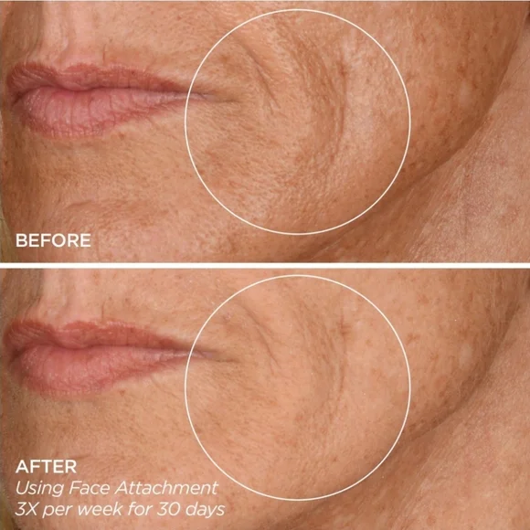 GloPRO Facial Microneedling Tool in LIMITED EDITION PINK STRIPE, New In Case - Picture 7 of 7